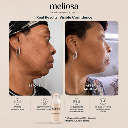 Meliosa™ Micro-Infusion System